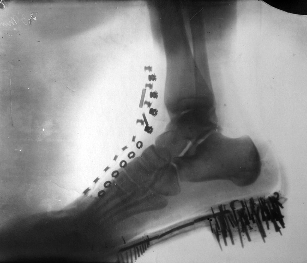 рентген ноги Теслы